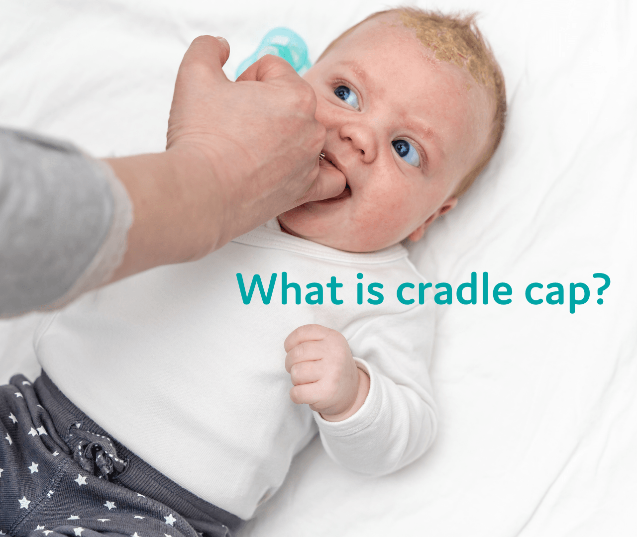 Cradle Cap: What it is? Where does it occur? How do you treat it? – T ...